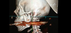brazilian woman + 1 centimeter away from death