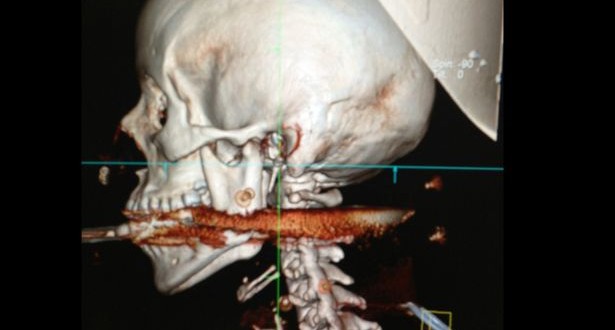 Brazilian woman 1 centimeter away from death : harpoon victim photo