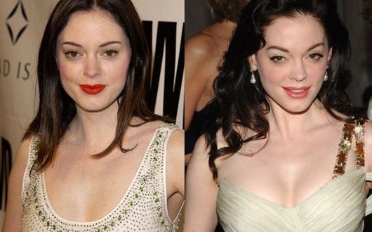 Rose mcgowan facelift, eyelids, fillers in lips and cheeks : Photo