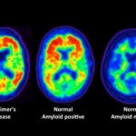 Alzheimer's Affected by Cholesterol Level