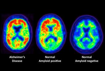 Alzheimer's Affected by Cholesterol Level