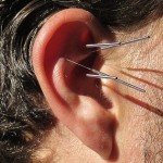 Ear acupuncture could help lose weight, Study