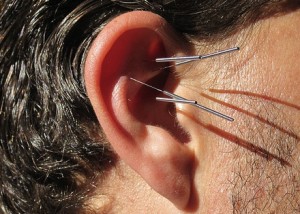 Ear acupuncture could help lose weight, Study