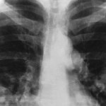 Breath Test May Detect Signs of Lung Cancer : New study