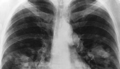 Breath Test May Detect Signs of Lung Cancer : New study