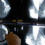 Cancer death rates decline in US