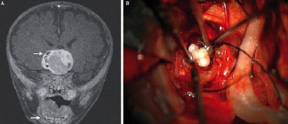 Rare Tumor Removed From Baby Had Teeth (Photo)