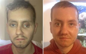 British Man Gets 3D-Printed Skull