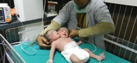 Two headed baby born in India