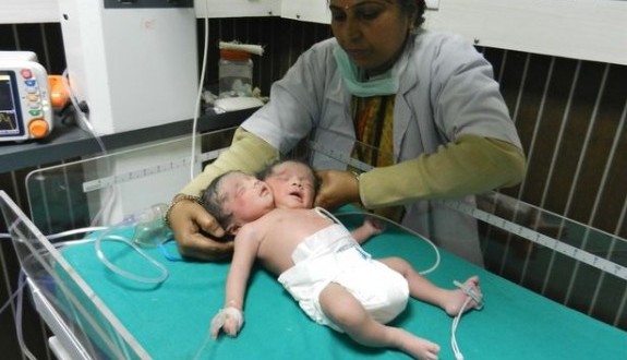 Two headed baby born in India