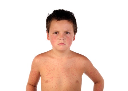 California measles outbreak is the worst in two decades