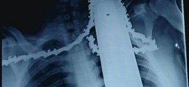 Workman Survives Chainsaw in Neck