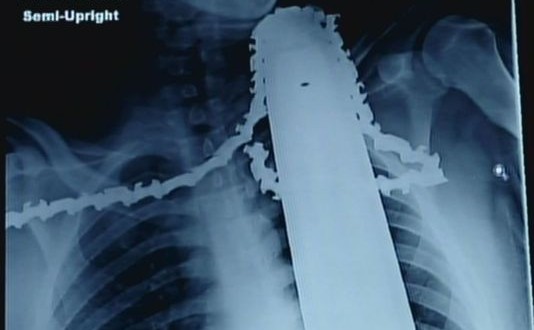 Workman Survives Chainsaw in Neck