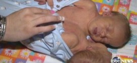 Parents Opt To Keep Conjoined Twins Together