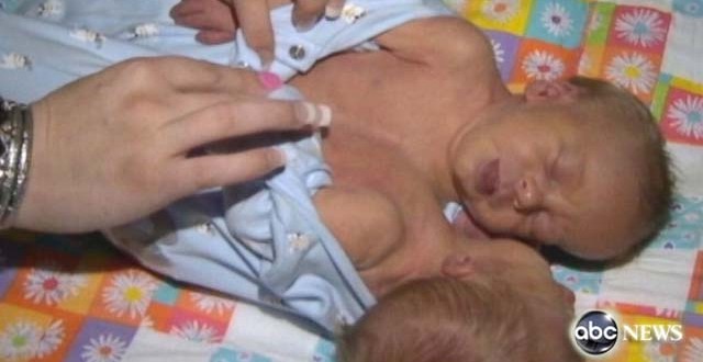 Parents Opt To Keep Conjoined Twins Together