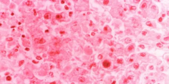 Rare West African virus confirmed in Minnesota traveler