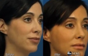 Triana Lavey : Woman Gets $15000 in Plastic Surgery to Improve Her Selfies
