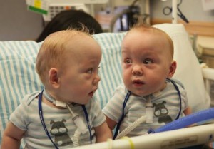 Conjoined Twins Leave Dallas Hospital after separation