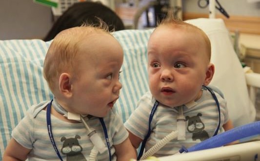 conjoined twins leave hospital