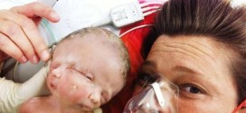 Australian Conjoined twins Faith and Hope have died after 19 days