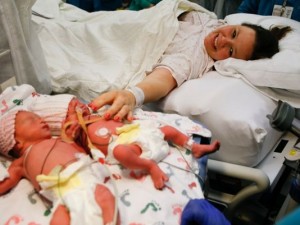 Monoamniotic twins arrive as early Mother's Day gift