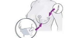 Orbix Medical : New plastic surgery installs 'internal bra' under the skin