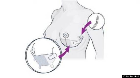 Orbix Medical : New plastic surgery installs ‘internal bra’ under the skin