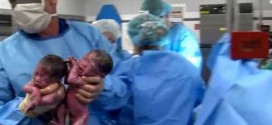 Second Set of 'Mono Mono' Twins Born in Same Hospital