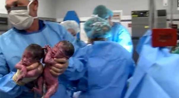 Ohio Hospital : Second set of mono mono twins born in a week
