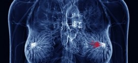 Breast cancer gene also points to lung risk, Study