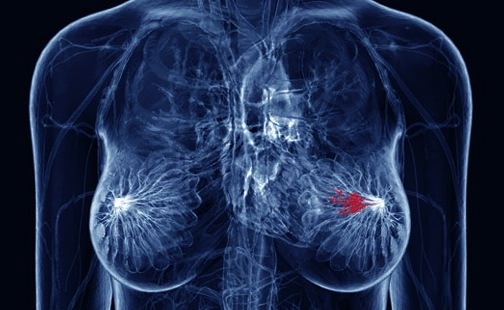 Breast cancer gene also points to lung risk, Study