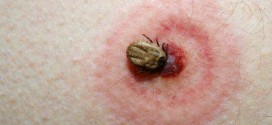 Health Talk: here's what you need to know about Lyme disease