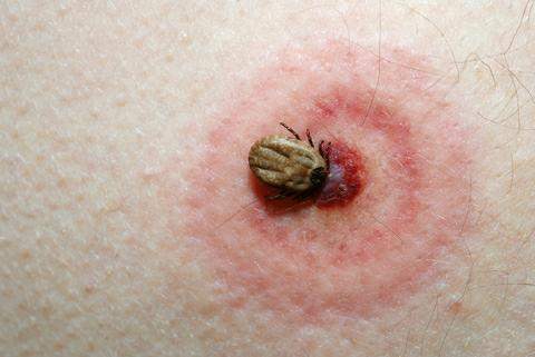 Health Talk: here’s what you need to know about Lyme disease