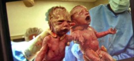 Rare 'mono mono' twins progressing in Ohio