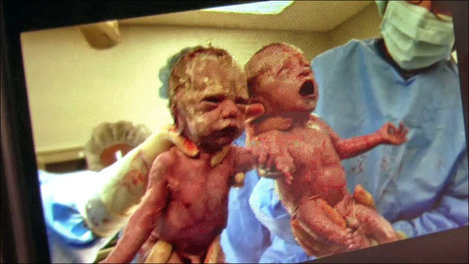 Rare 'mono mono' twins progressing in Ohio