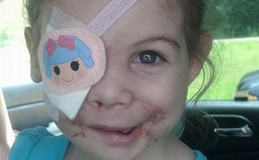 Victoria Wilcher Girl scarred by pit bull attack asked to leave KFC