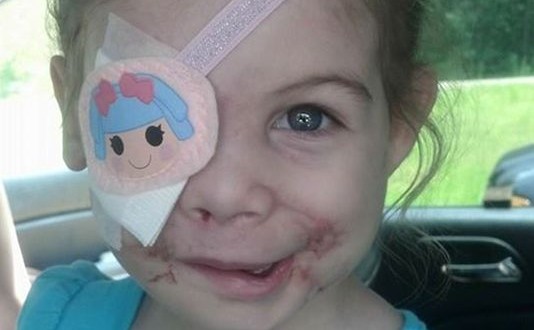 Victoria Wilcher : Girl scarred by pit bull attack asked to leave KFC