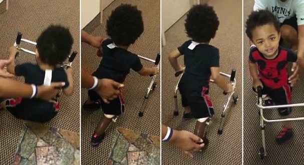 2-year-old amputee takes first steps with a prosthet (Video)