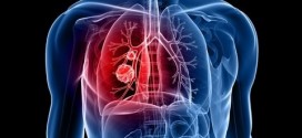 AstraZeneca Collaborating With Roche, QIAGEN On Lung Cancer Tests, Report