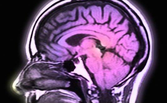 Schizophrenia Gene Study May Point to New Treatment, Report