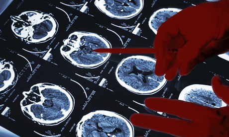 Strokes in US Drop Two-Fold in Past Two Decades, Study Says