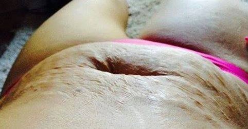 Alberta woman responds to stretch mark taunters on Facebook