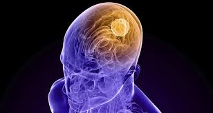 Scientists Explain Why Brain Tumors Occur More Often In Males