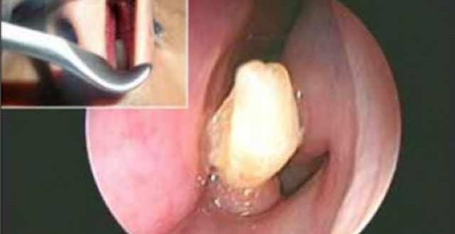 Tooth In Man's Nose : Doctors Find Extra Tooth in Really Odd Place