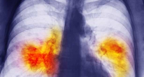US lung cancer rates falling overall, Study