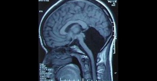 24-year old woman discovers part of her brain is missing