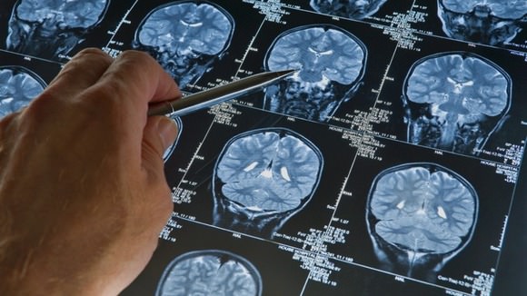 Feds announce funding for dementia research, Report