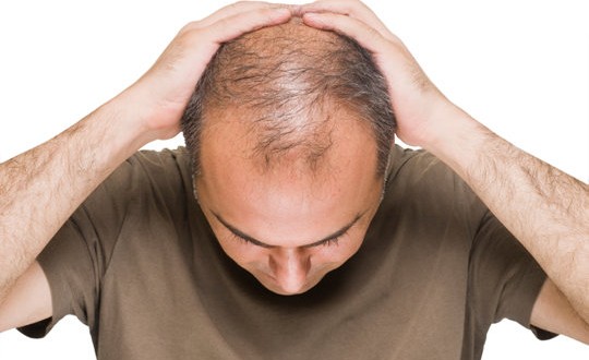 Male-Pattern Baldness Linked to Aggressive Prostate Cancer, Study