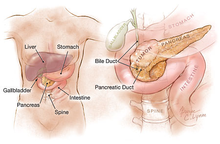 Researchers Detect Early Sign of Pancreatic Cancer