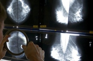 Risks of Breast Cancer Screening in Women 70-Plus, Report